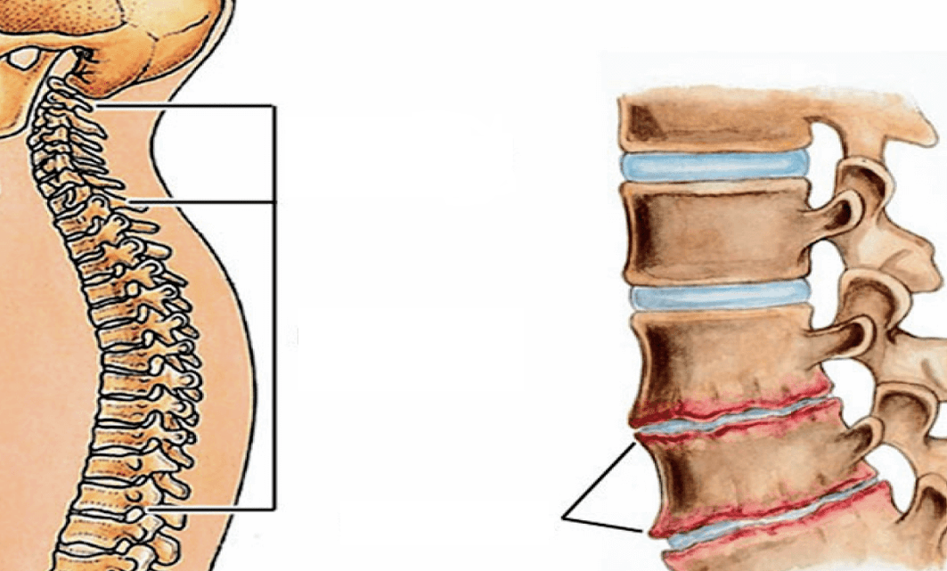 Come appare l'osteocondosi della colonna vertebrale