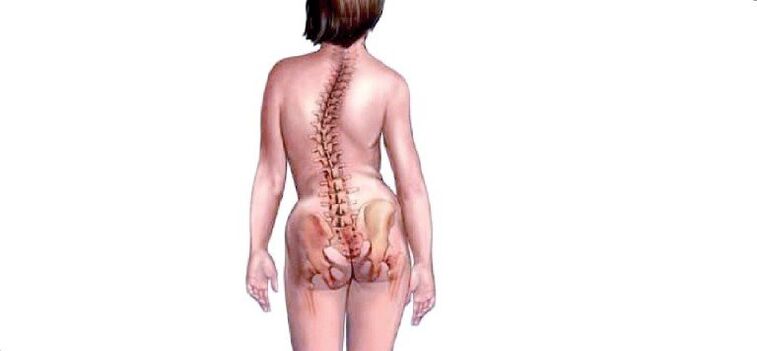 Osteocondrosi