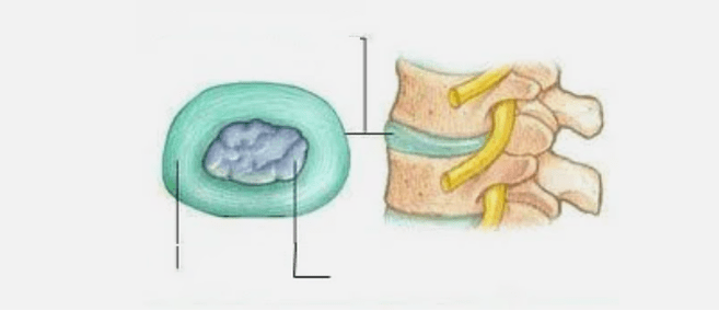 Tipo di osteocondrosi