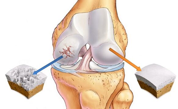 cartilagine sana affetta da osteoartrite